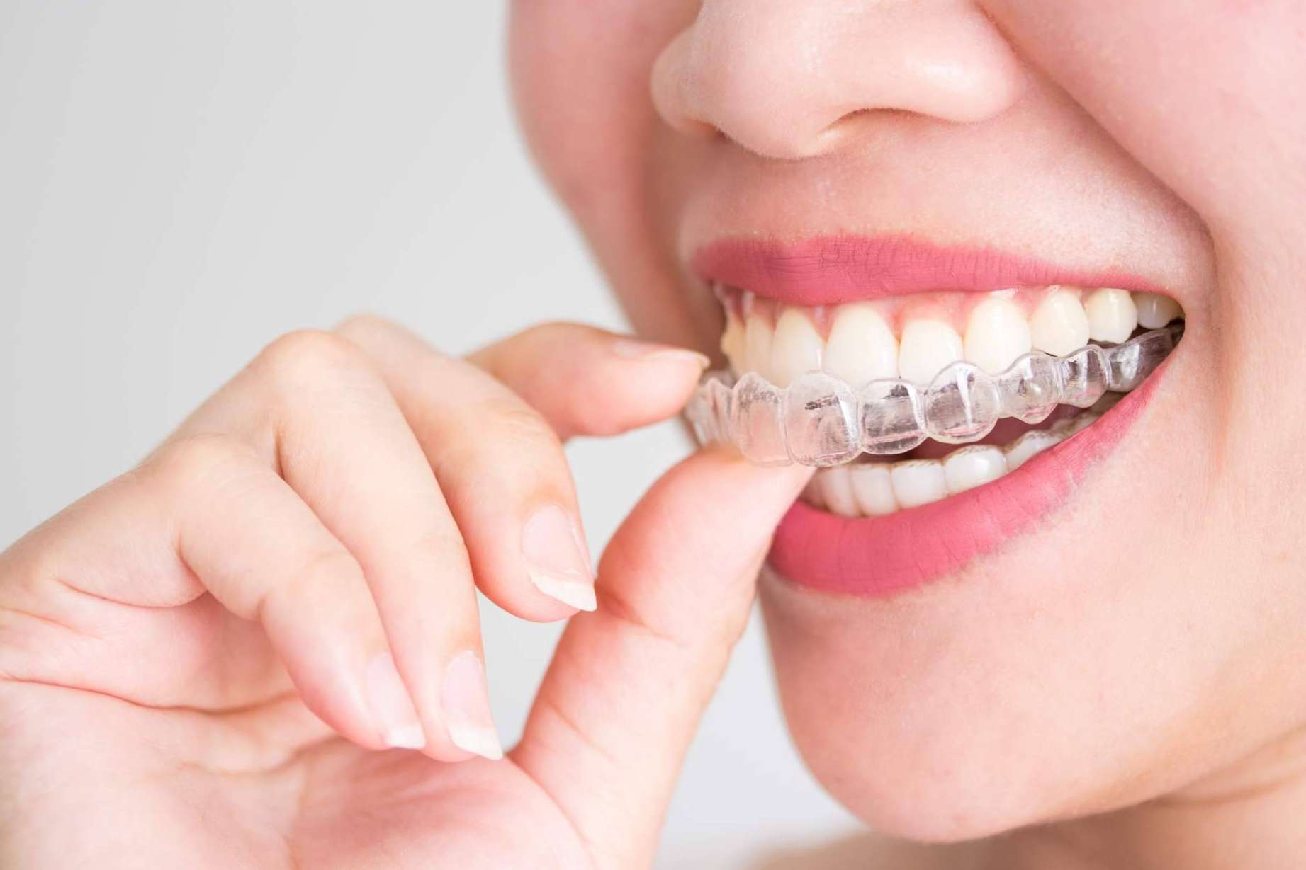 Las ventajas del tratamiento de ortodoncia con brackets, por Helident Clínica Dental