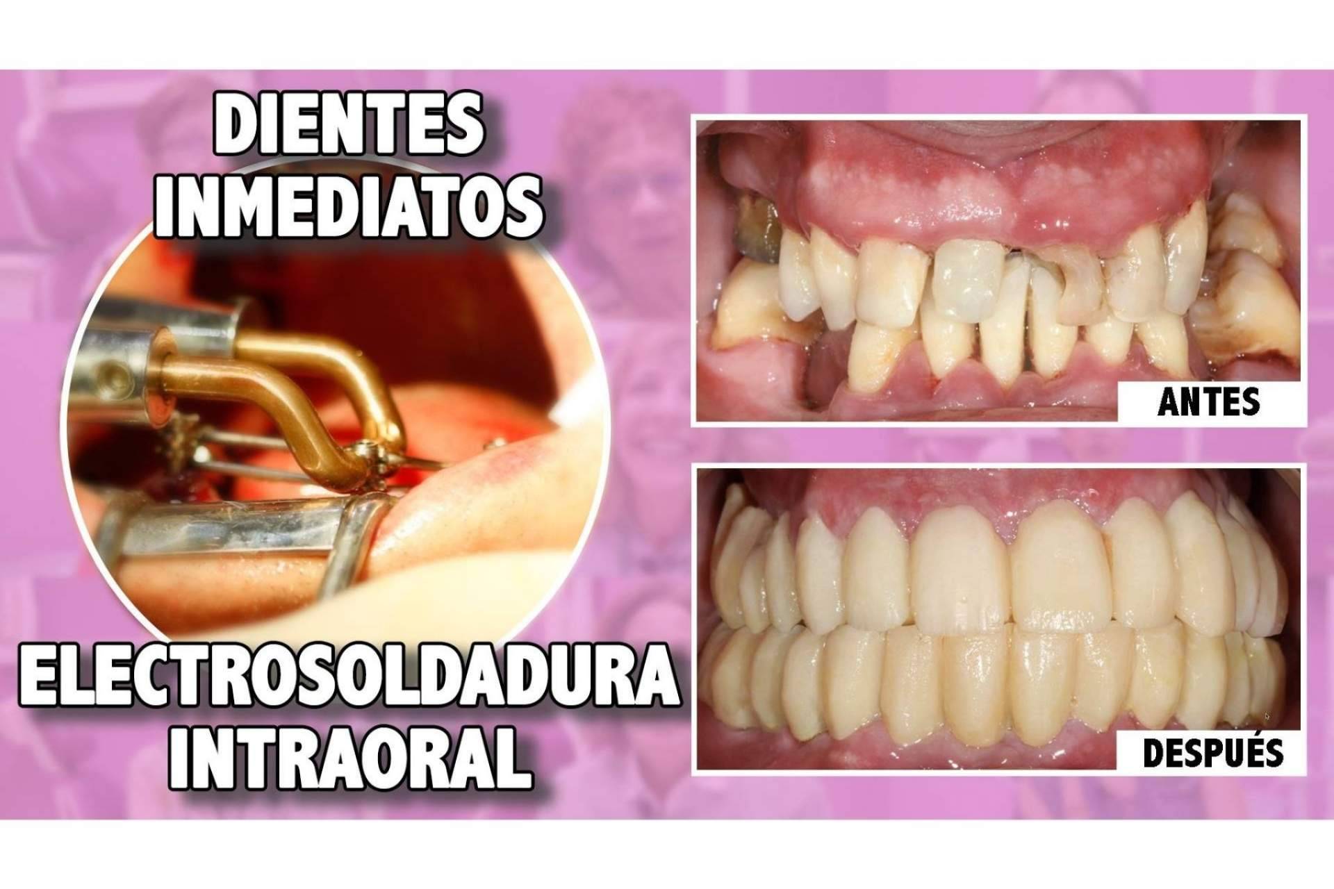 Los pacientes encuentran múltiples ventajas en la técnica de implantes con dientes inmediatos del Dr. Ismael Soriano
