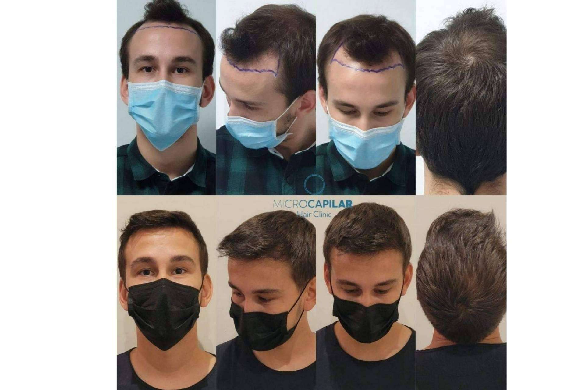 Las ventajas de realizar un injerto capilar en España con el servicio de Microcapilar Hair Clinic