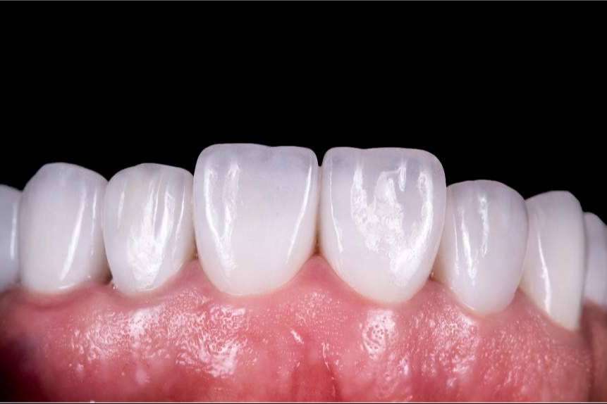 En Hospitalet, Clínicas Qualident ofrece implantes dentales innovadores