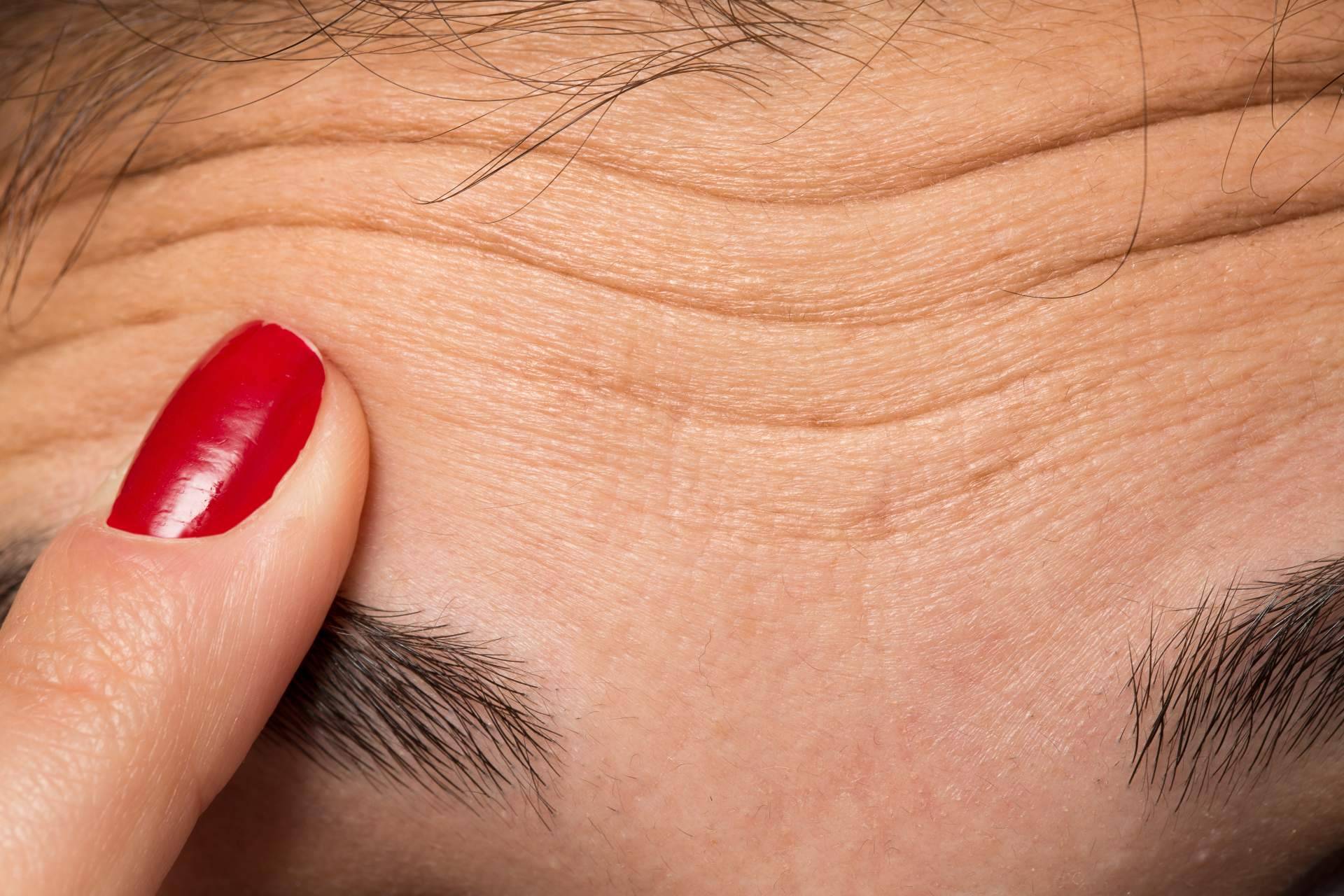 Diseño de cejas con bótox en la Clínica de Medicina Estética Sánchez Peral en Castellón