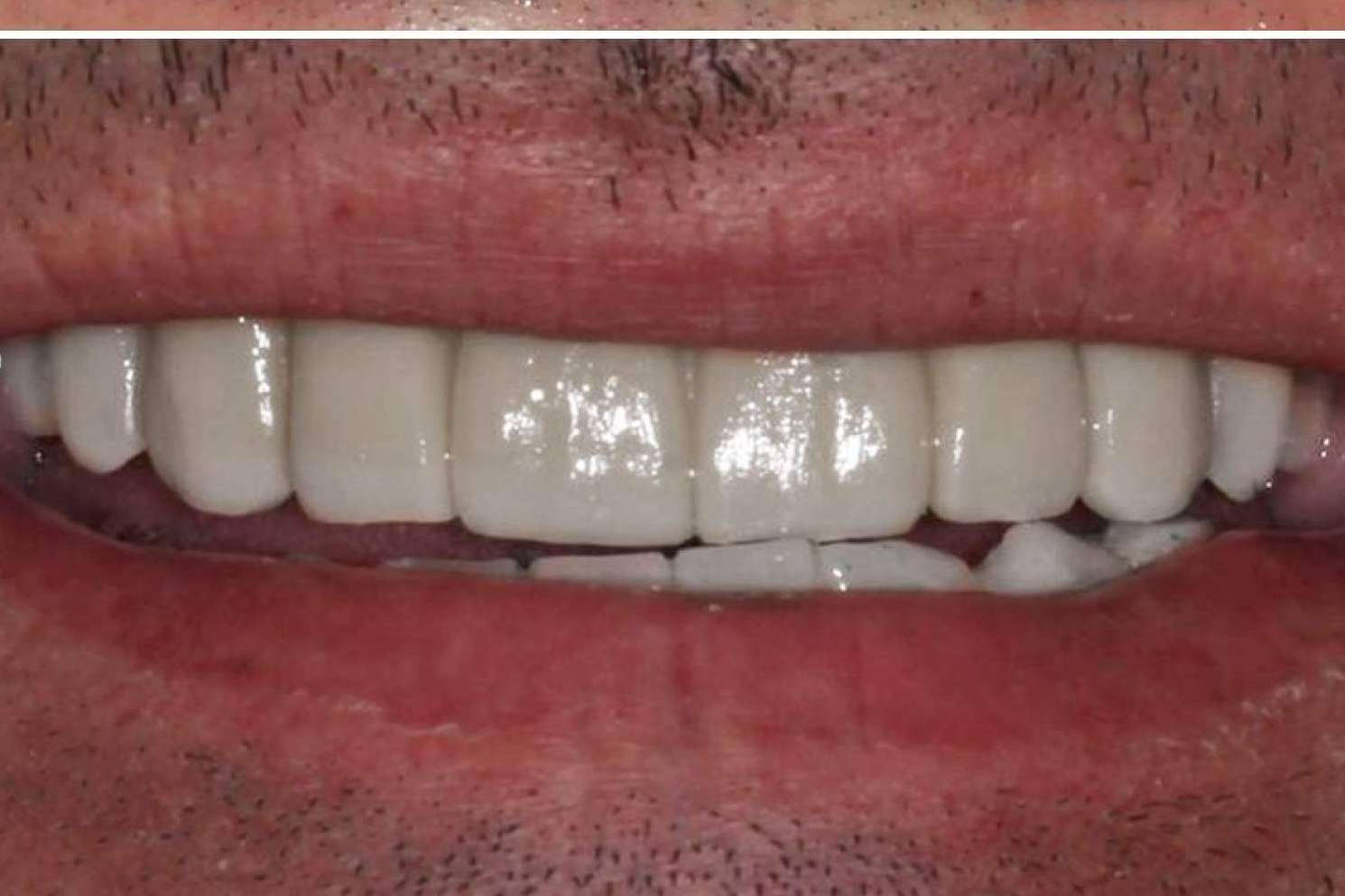 ¿Cuáles son los beneficios del tratamiento ALL ON 4 de Implant Clinics?