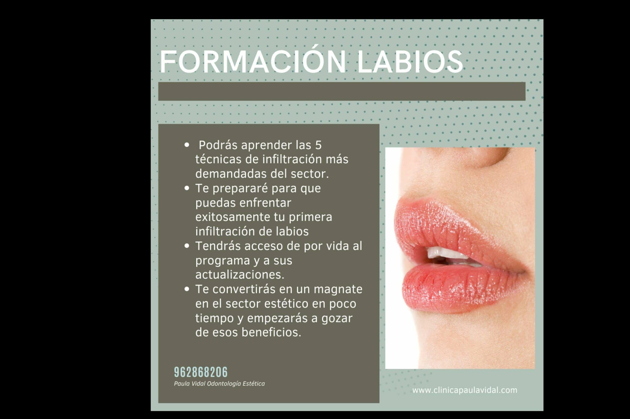 Para odontólogos, Clínica Paula Vidal ofrece un curso de relleno de ácido hialurónico