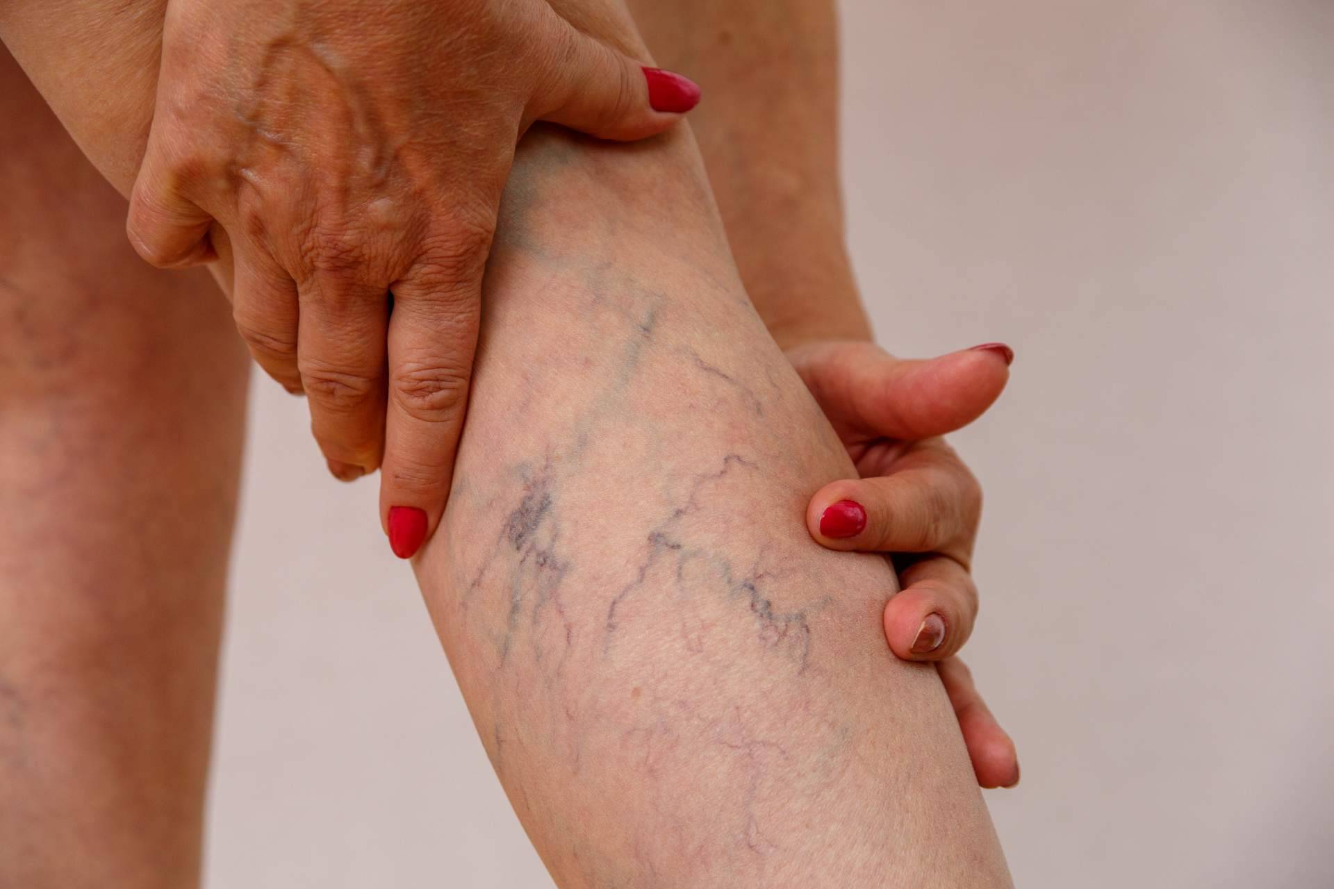 Decir adiós a las arañas y las varices con el tratamiento con láser de la Doctora Sánchez-Peral