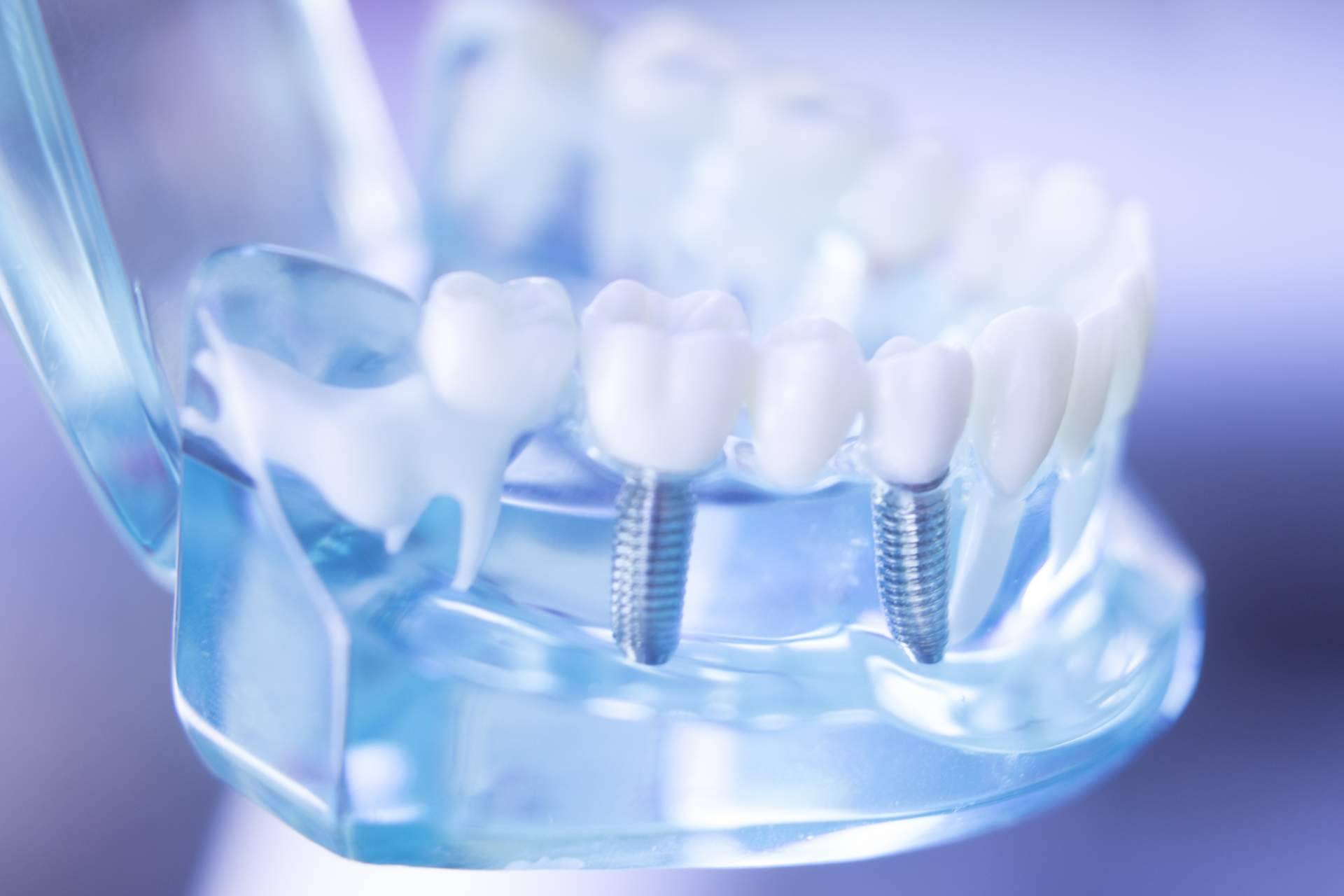 Las ventajas de los implantes cigomáticos de la clínica Corrales Dental