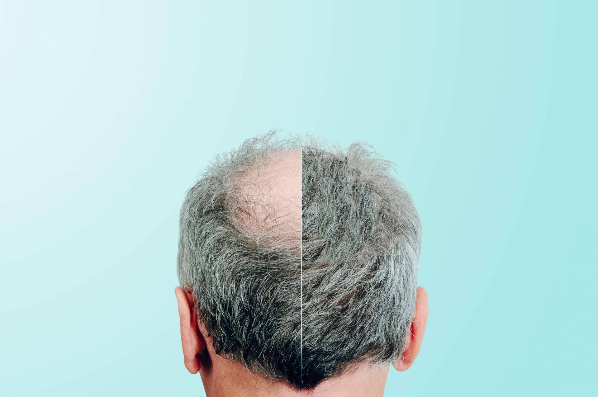 Poner fin a la alopecia con Nanofat, el tratamiento capilar de Clínica Tarrazo