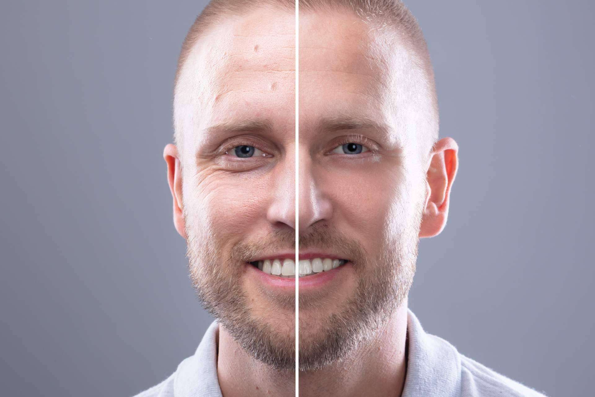 Blefaroplastia sin cirugía con el plasma láser de Alluring Clinic