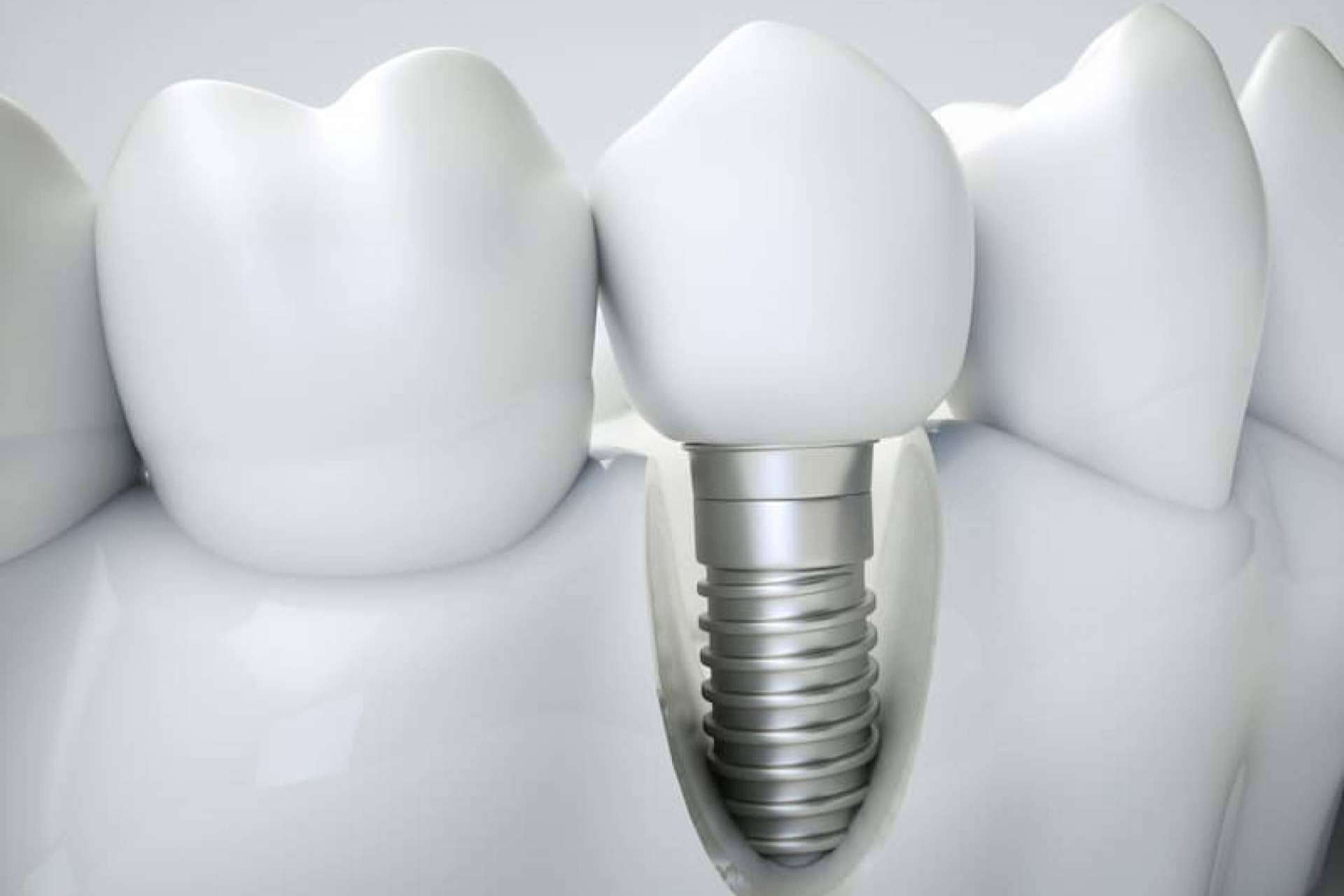Clínica Dental Ahoa y la implantología dental de carga inmediata