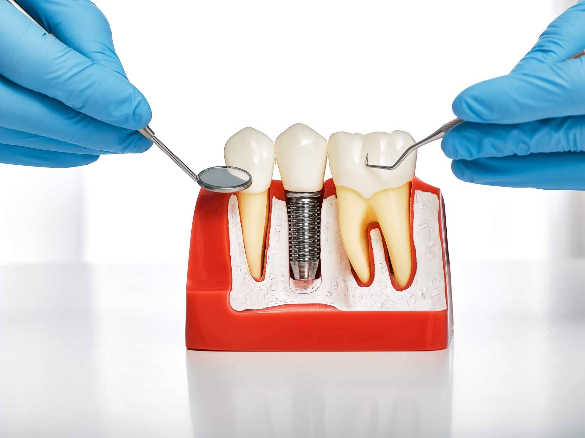 Implantes postextracción con carga inmediata, la técnica de Clínica Dental Sonrisas para lograr una dentadura excelente en sus pacientes