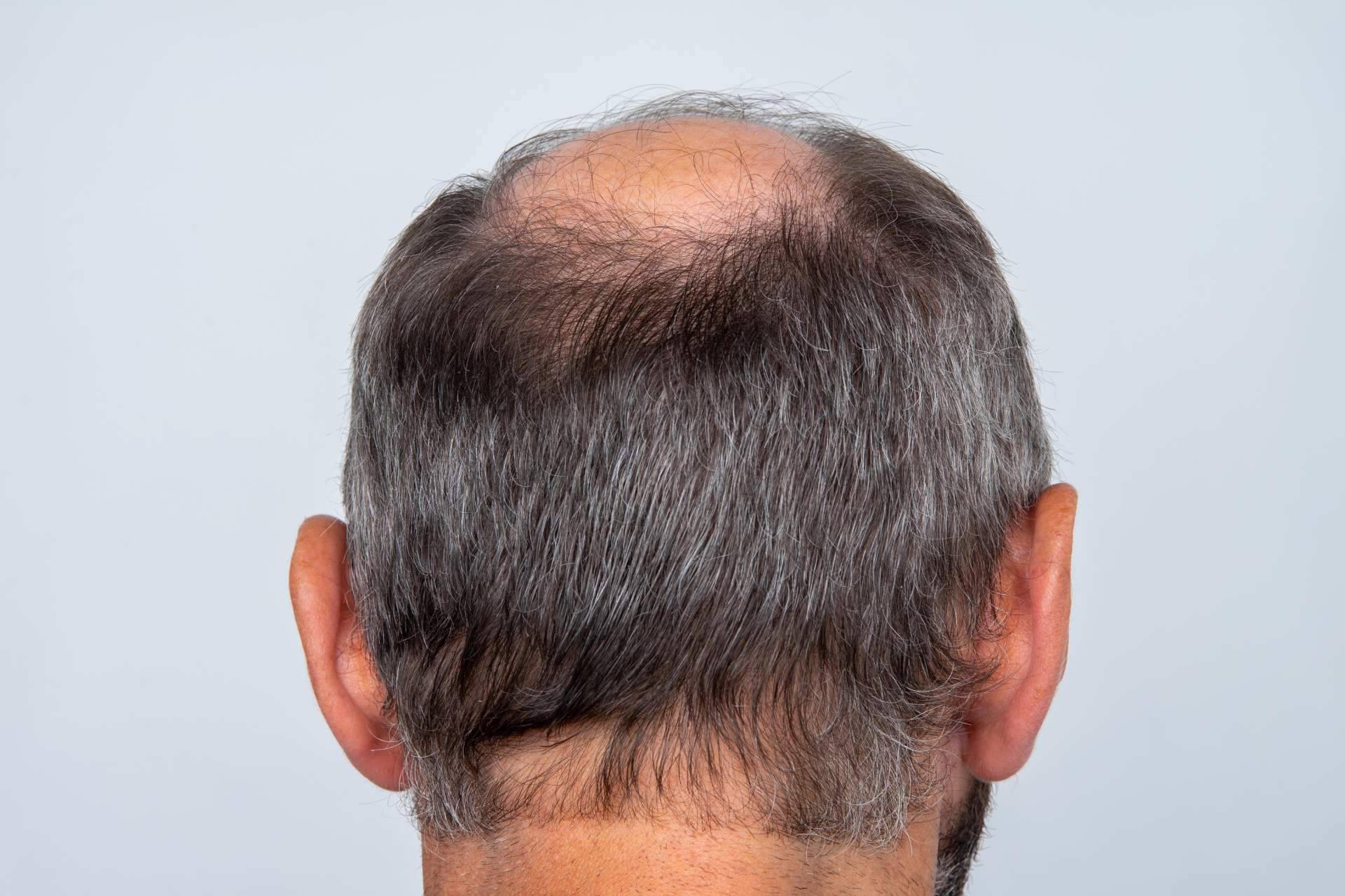 ¿En qué consiste el tratamiento de micropigmentación capilar?, por Élite Capilar