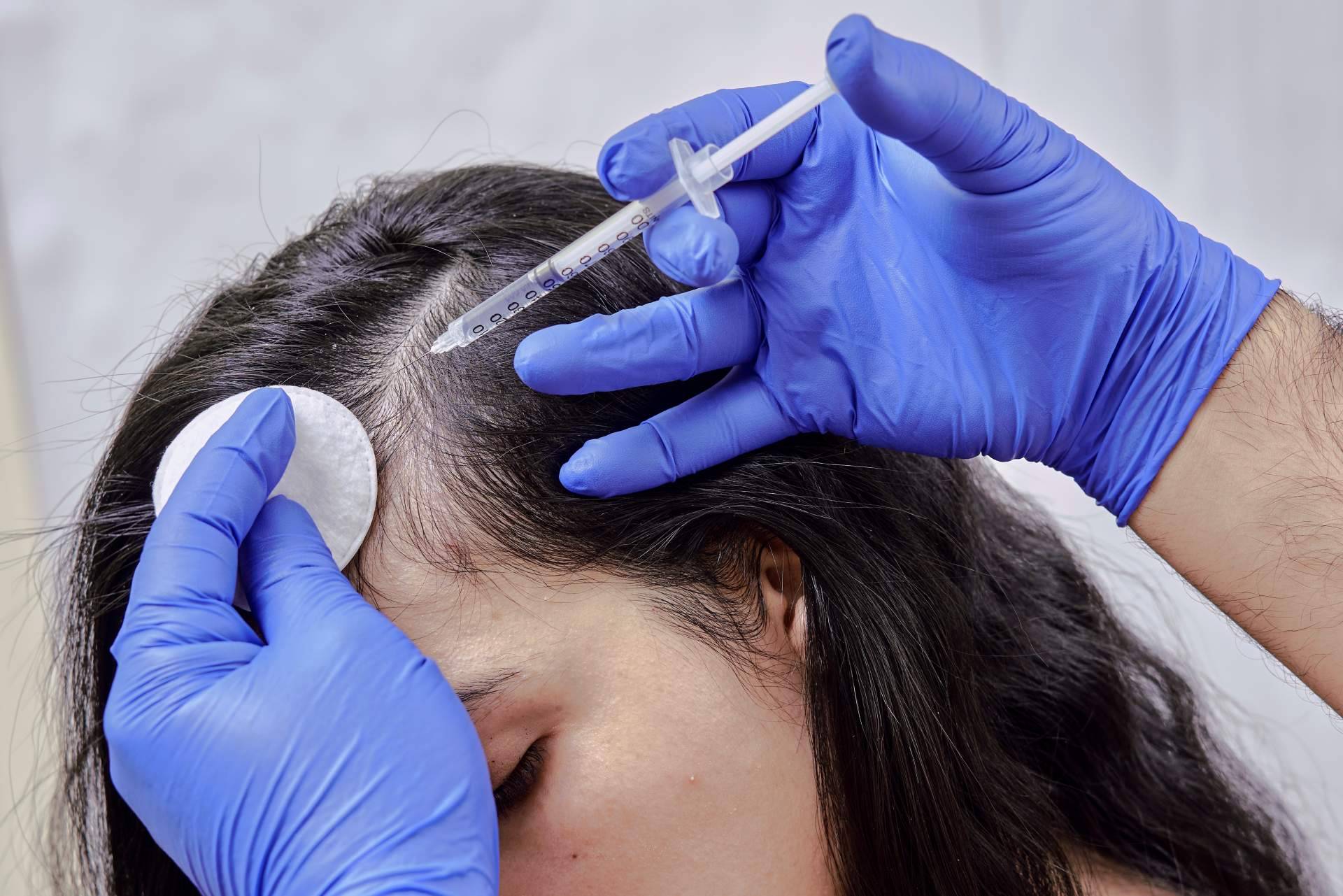 ¿En qué consiste la mesoterapia capilar y cuáles son sus efectos y recuperación?, por Élite Capilar