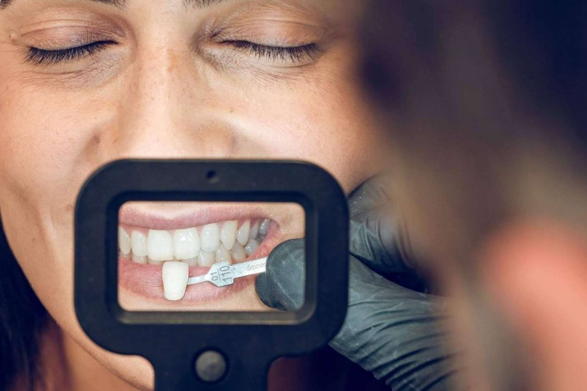 Recuperar la sonrisa es posible gracias a las carillas dentales