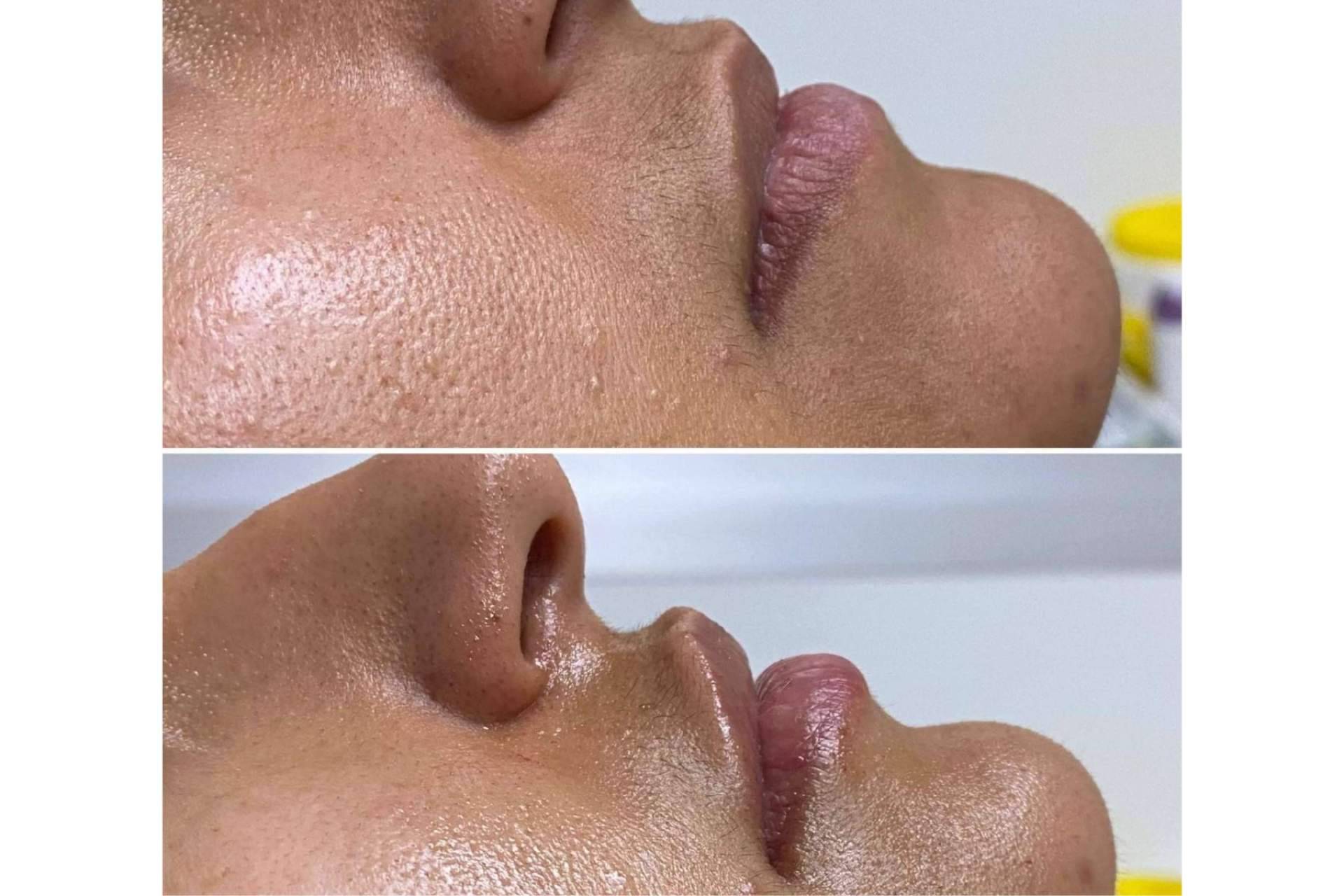 El tratamiento de aumento de labios que ofrece la Clínica Yasmin