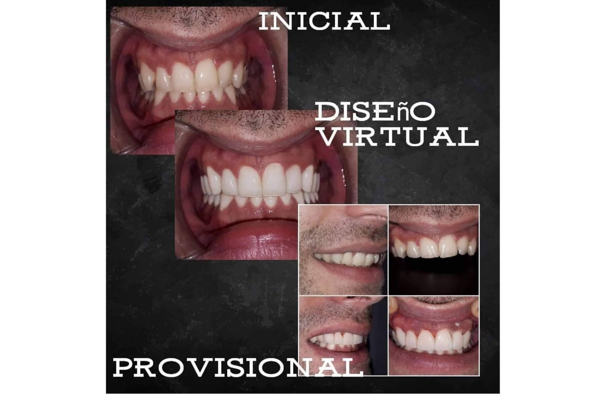 Dentinova ofrece alineación dentaria sin ortodoncia