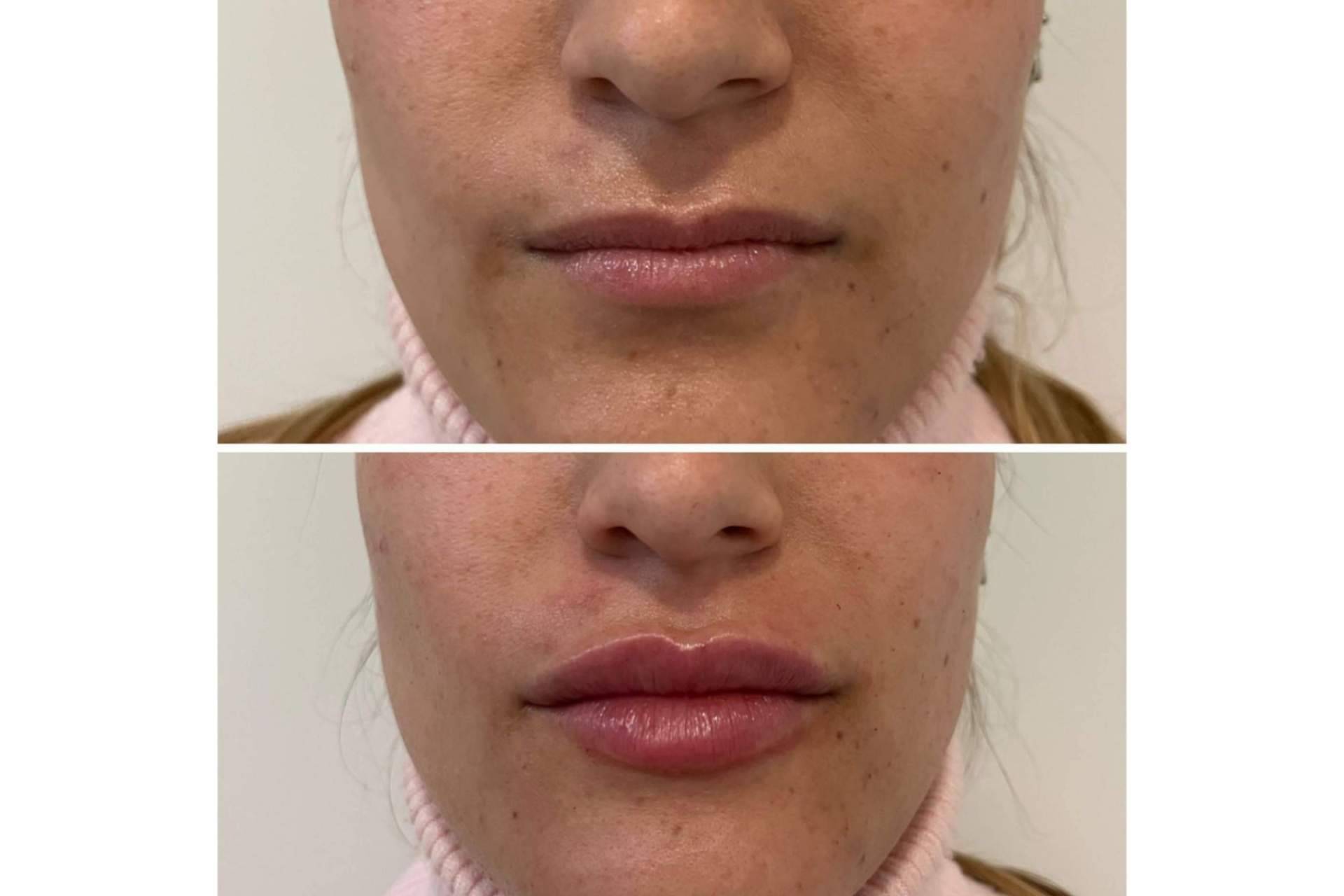 ¿Se puede conseguir un aumento de labios en Madrid con resultados naturales?, por la Dra. Cecilia Arthur
