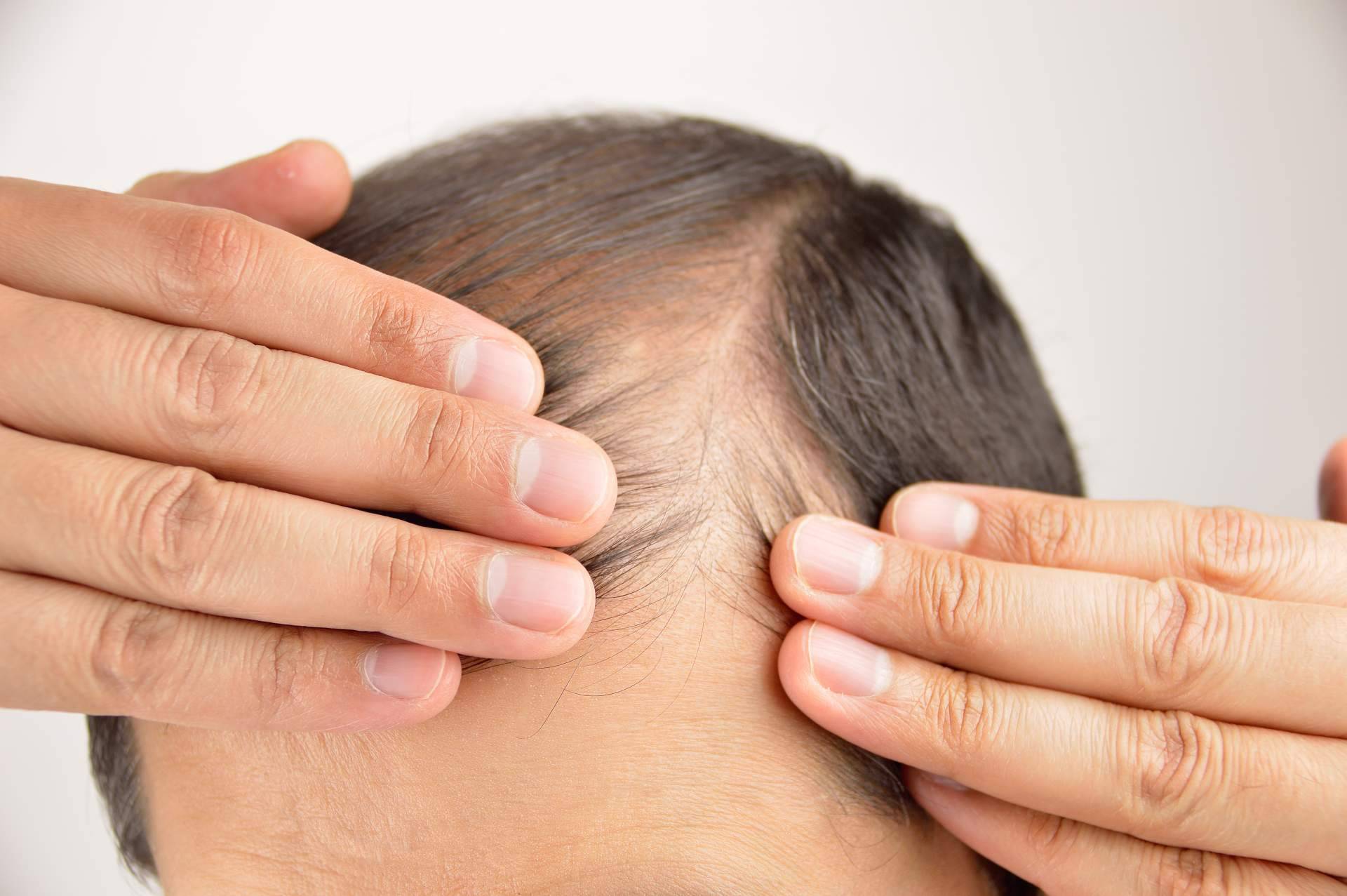 Élite Capilar se especializa en la realización de trasplante de cabello con la técnica Zafiro FUE en Benidorm, Elche y Villena y Madrid