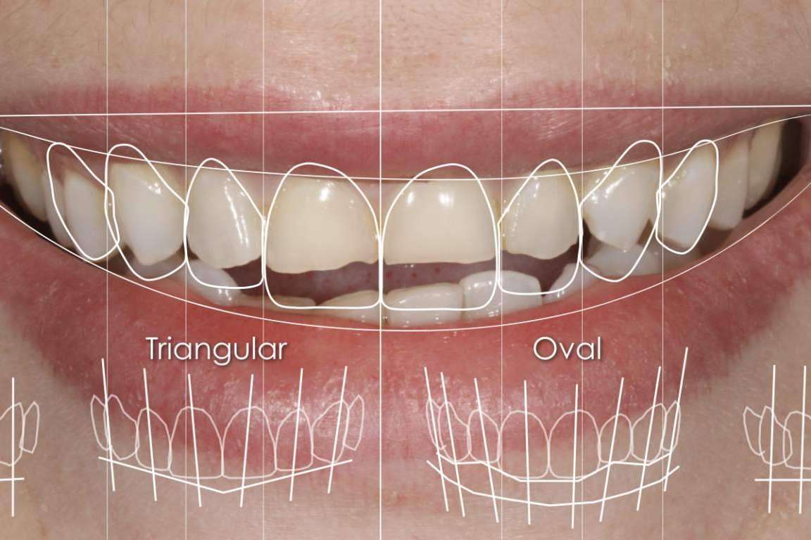 Razones para realizarse un diseño de sonrisa en la Clínica Dental Ruiz de Gopegui