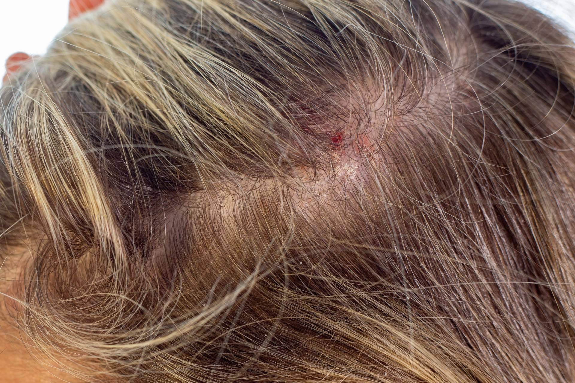 Dermatitis seborreica es una afección que puede generar alopecia si no se trata