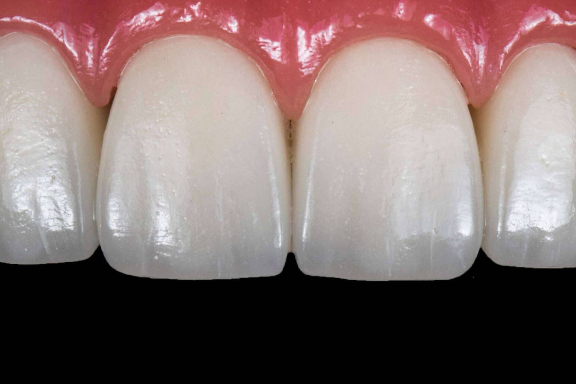 Corporación Dental lleva a cabo implantes de carga inmediata en Antequera