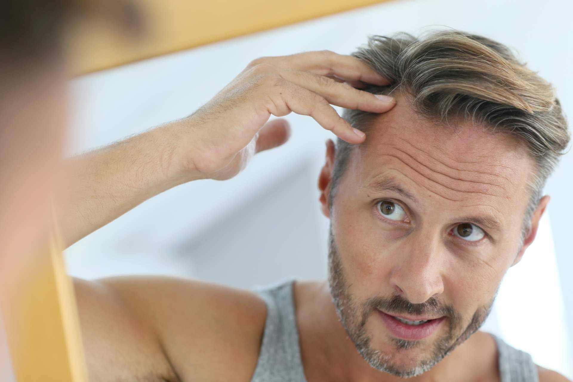 MC360 explica cuál es la mejor edad para hacerse un injerto capilar