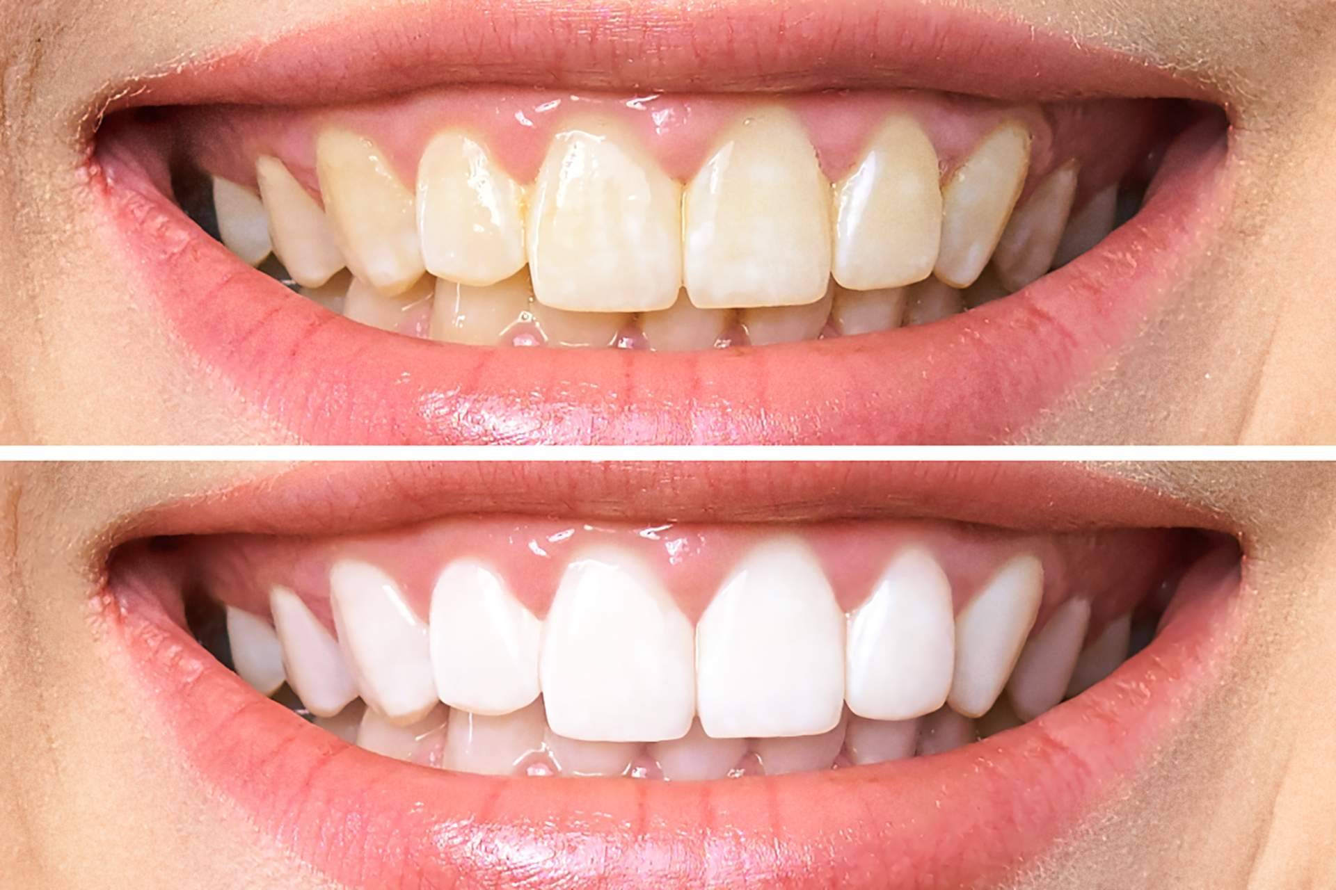 ¿Cómo se realiza un blanqueamiento dental? de la mano de Clínica Dental Delgado