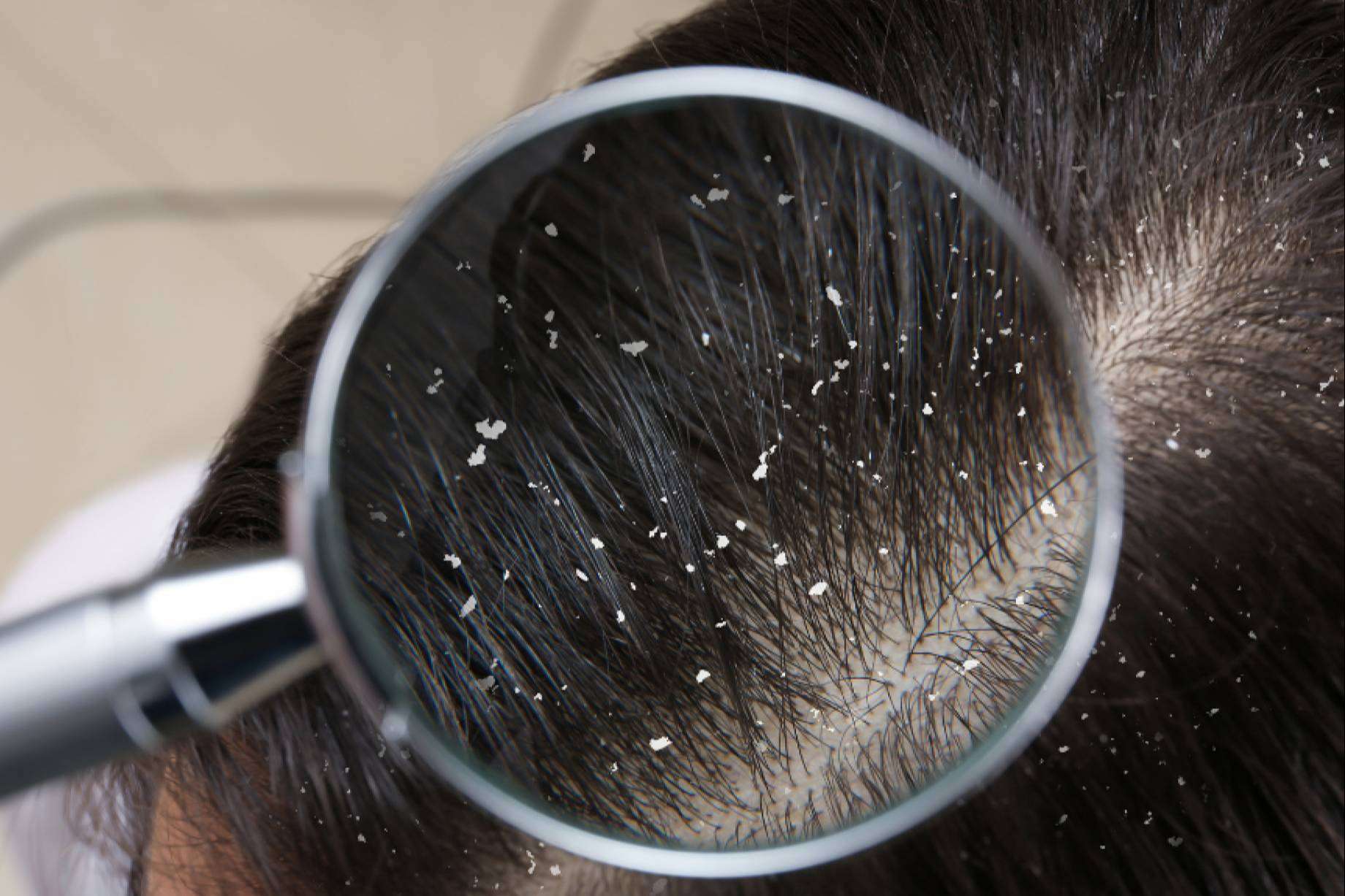 La caspa podría ser culpable de la caída del cabello