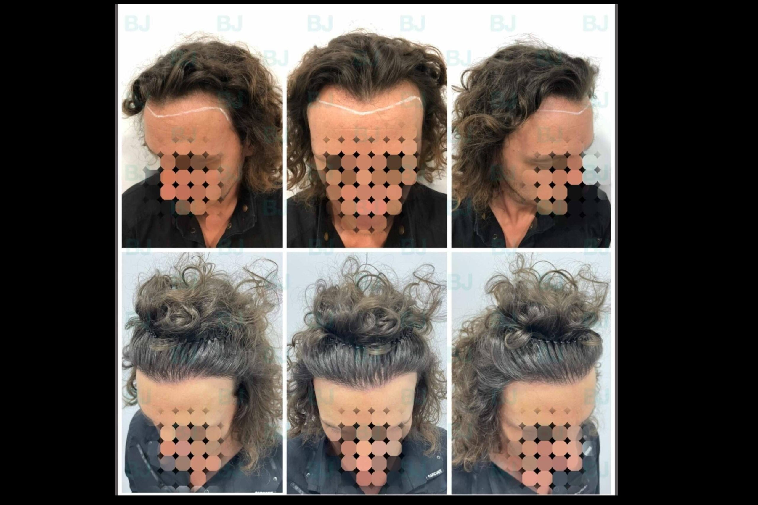 El Dr. Bruno Jacobovski recurre a las técnicas más modernas a la hora de llevar a cabo un tratamiento capilar