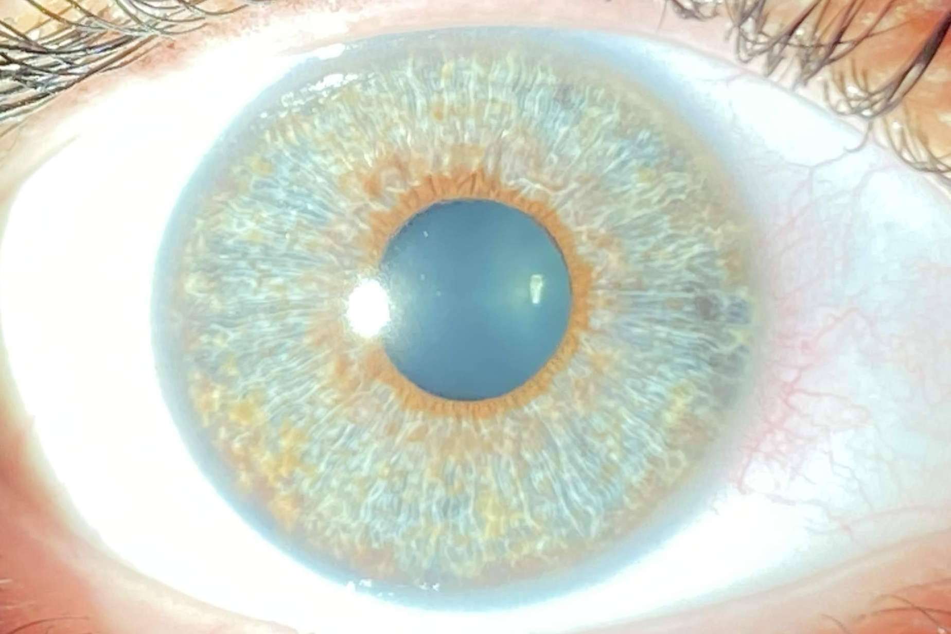 Los avances en las operaciones de cambio de color de ojos con láser, de la mano de Clínica Eyecos