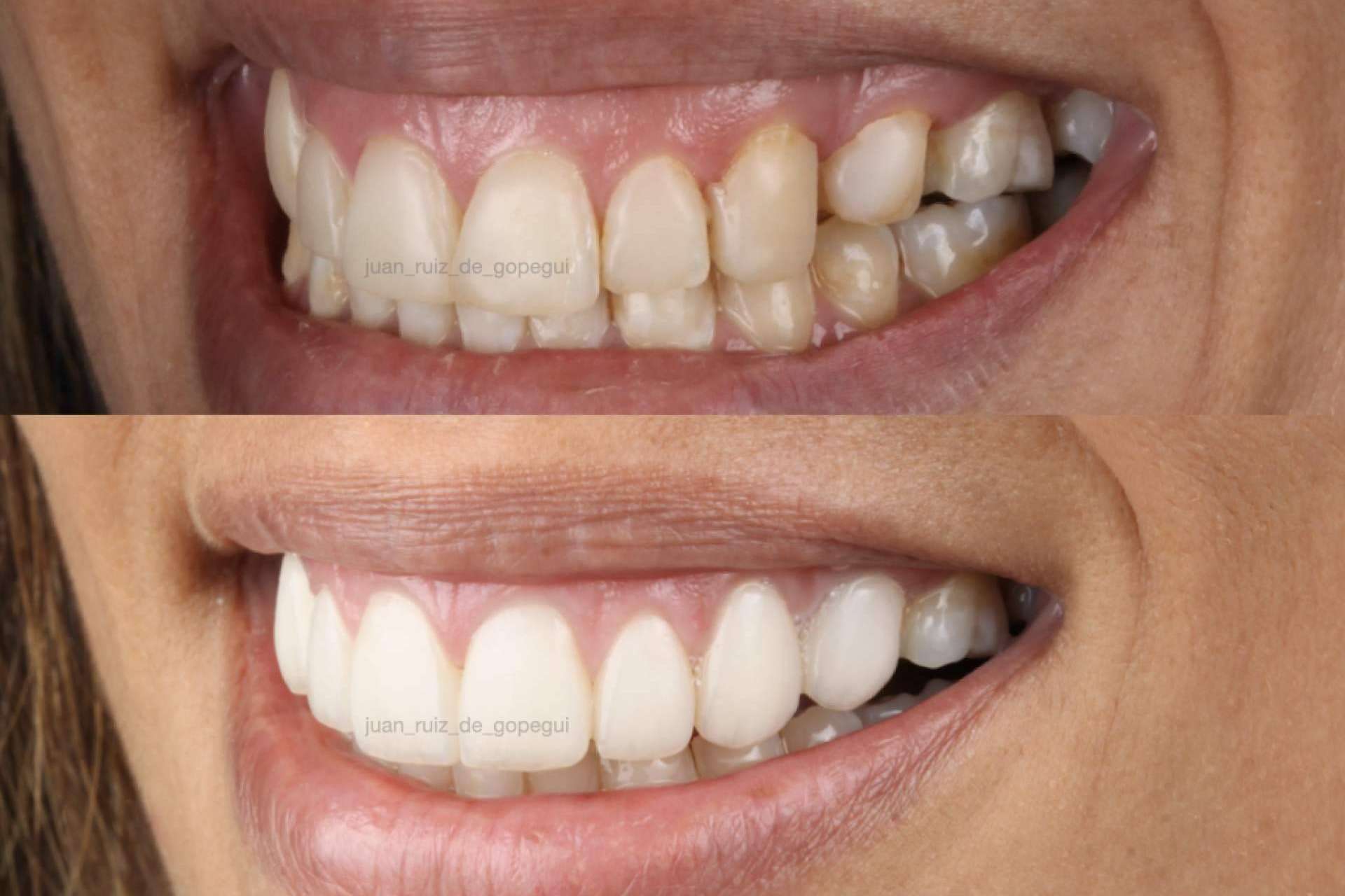 Razones por las que elegir las carillas de porcelana para mejorar la sonrisa