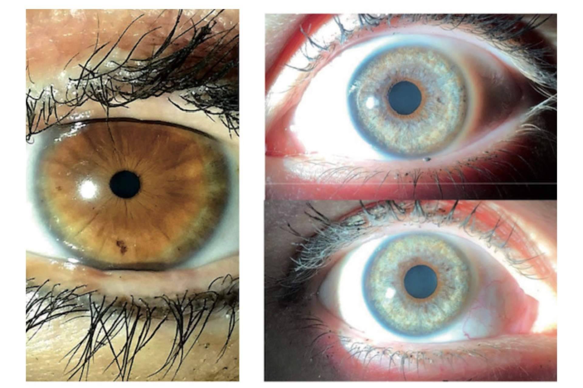 Clínica Eyecos informa de que los productos crece pestañas pueden oscurecer los ojos