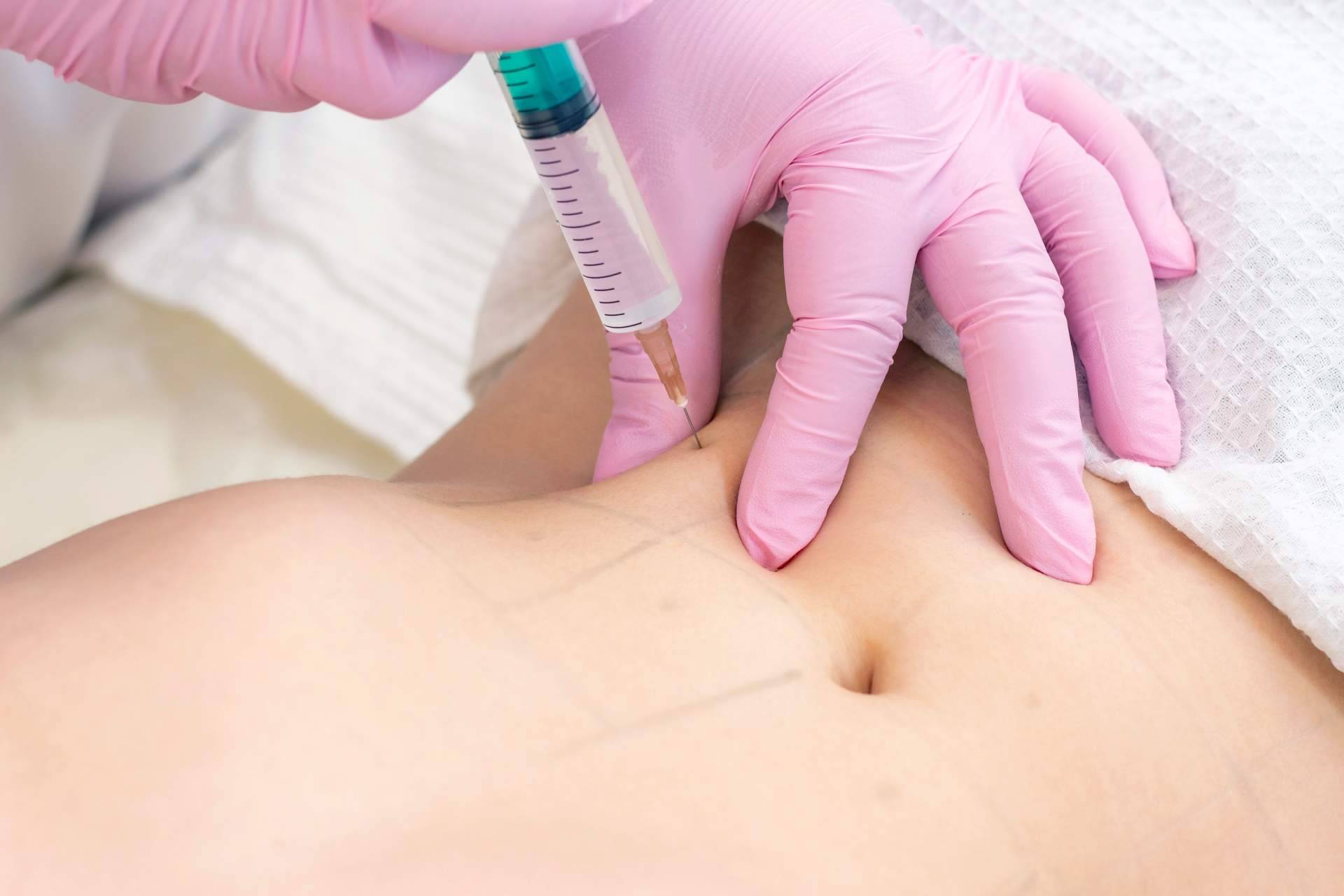 Mesoterapia efectiva contra la celulitis de la mano de Alluring Clinic