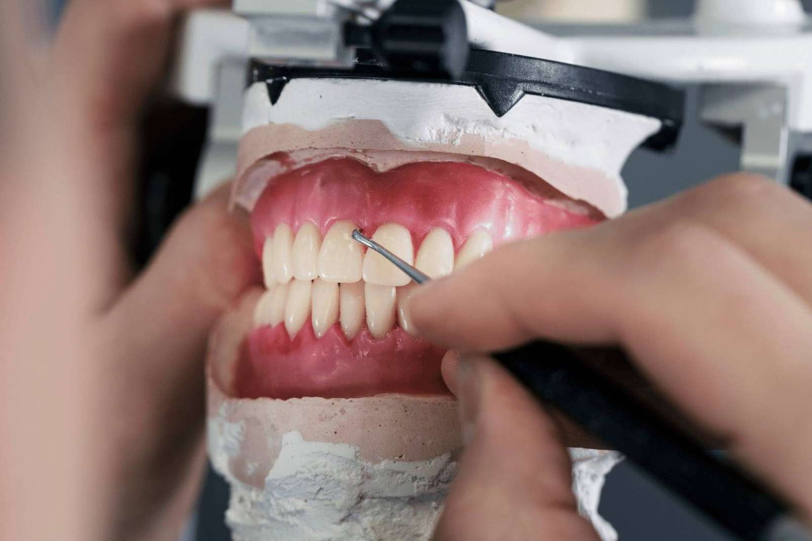 Recuperar la sonrisa perfecta con ayuda de coronas dentales, la solución estética y duradera que ofrece la Clínica Dental Ruiz de Gopegui