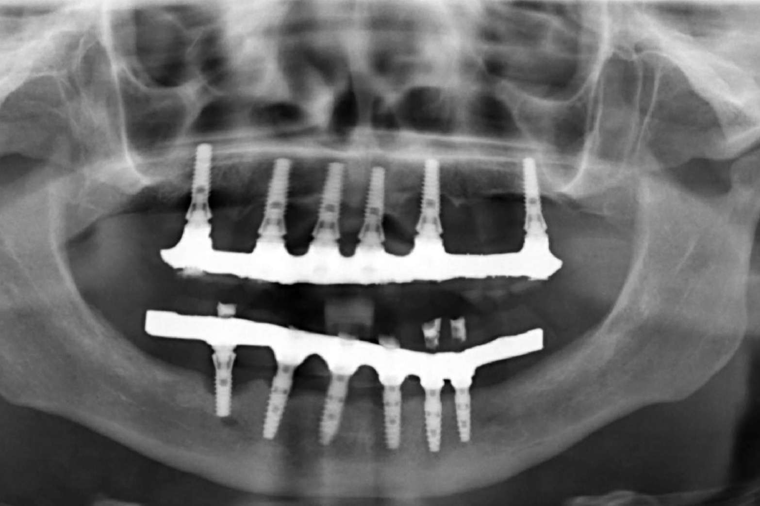Clínica Calvo de Mora acerca de los implantes dentales que lleva a cabo