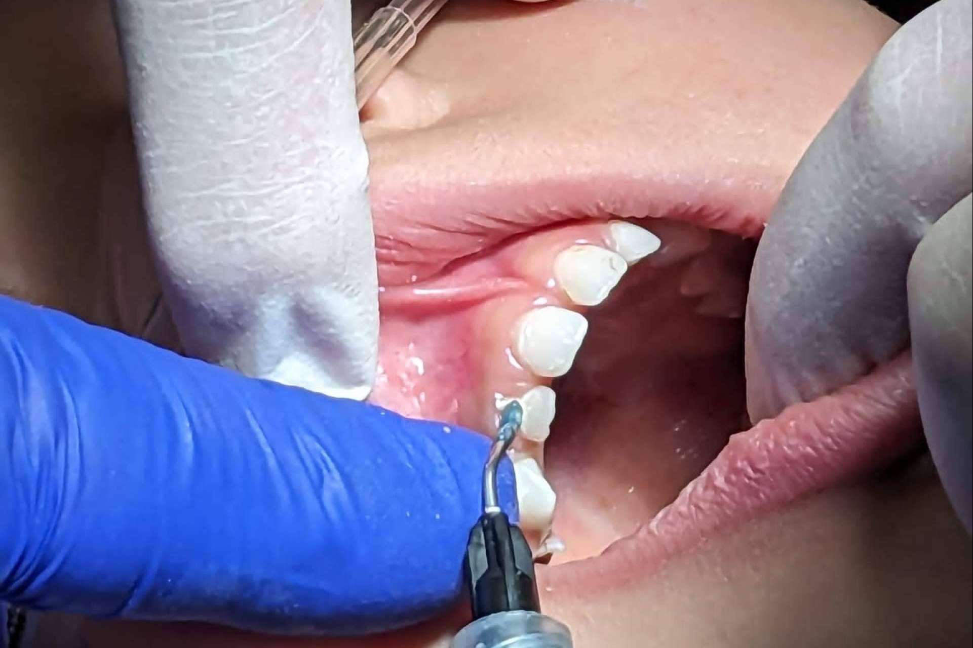 Clínica Dental Ulman, la sedación consciente para una experiencia sin miedo al dentista