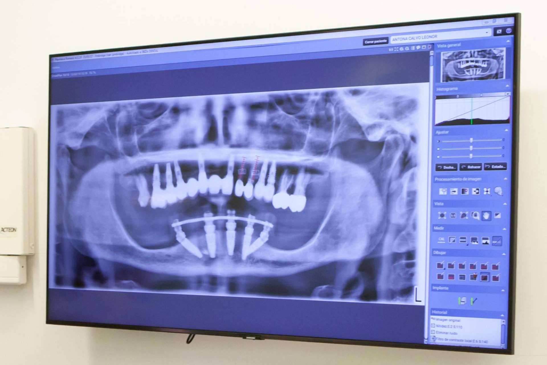 Edentulismo con Clínica Dental Ruiz de Gopegui, ¿Qué es y cómo tratarlo?