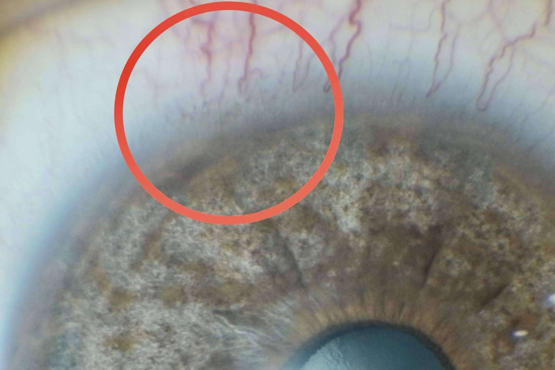 Tratamiento láser de las manchas pigmentarias de la conjuntiva