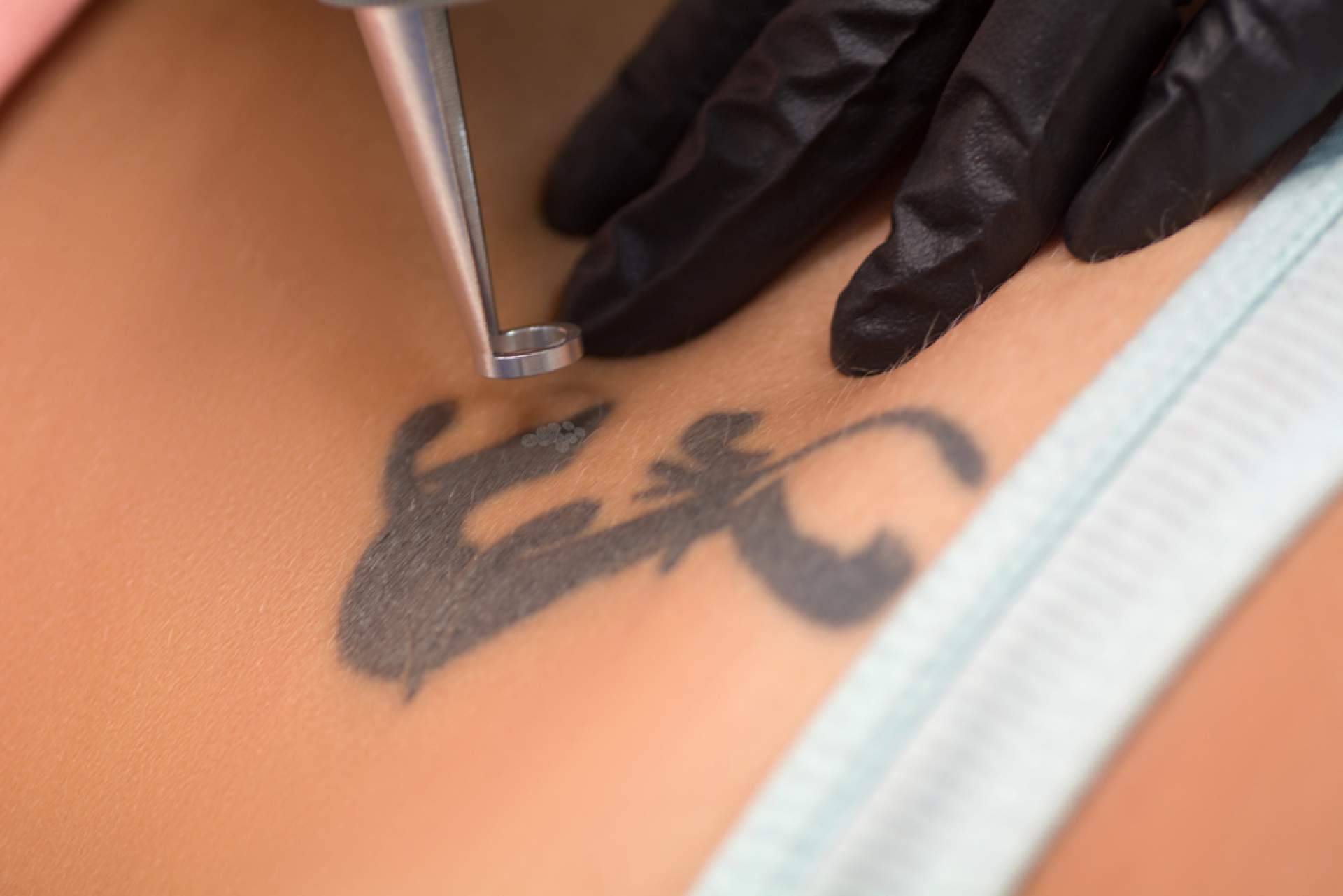 ¿Se pueden eliminar tatuajes a color? Todo lo que ofrece Ink Láser Alicante