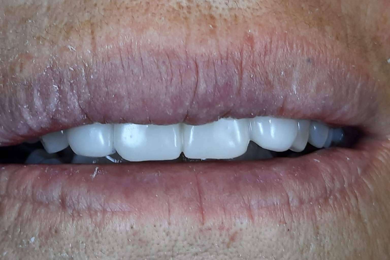 Clínica Biorigenera, especialistas en recuperar la sonrisa y la salud bucodental con implantes dentales cerámicos