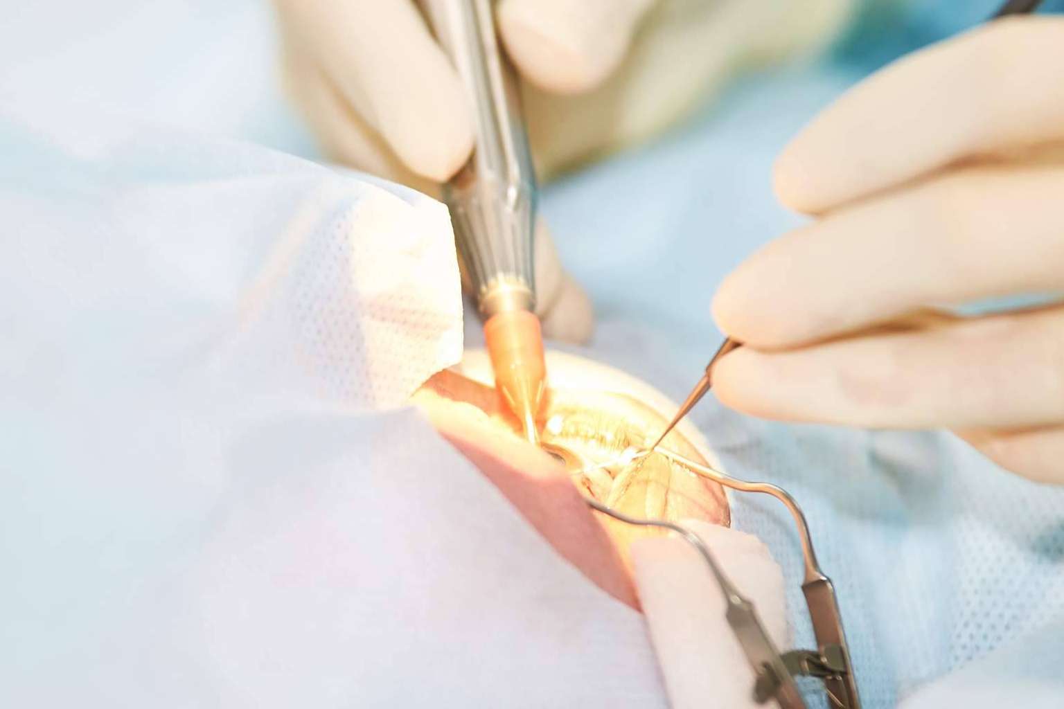 Realizarse una cirugía refractiva en el Departamento de Oftalmología del Hospital Universitari Dexeus