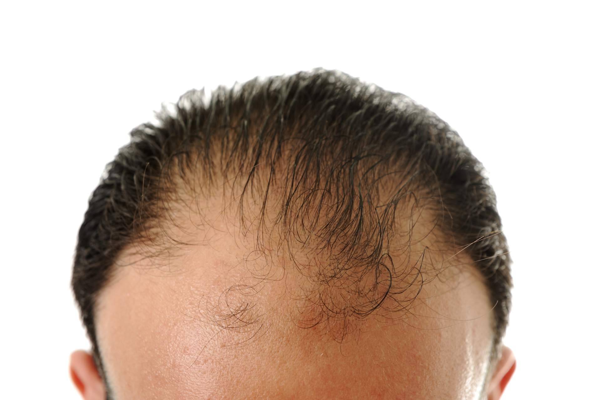 Champú Cleaner, la alternativa de Saw Palmetto contra la dermatitis seborreica