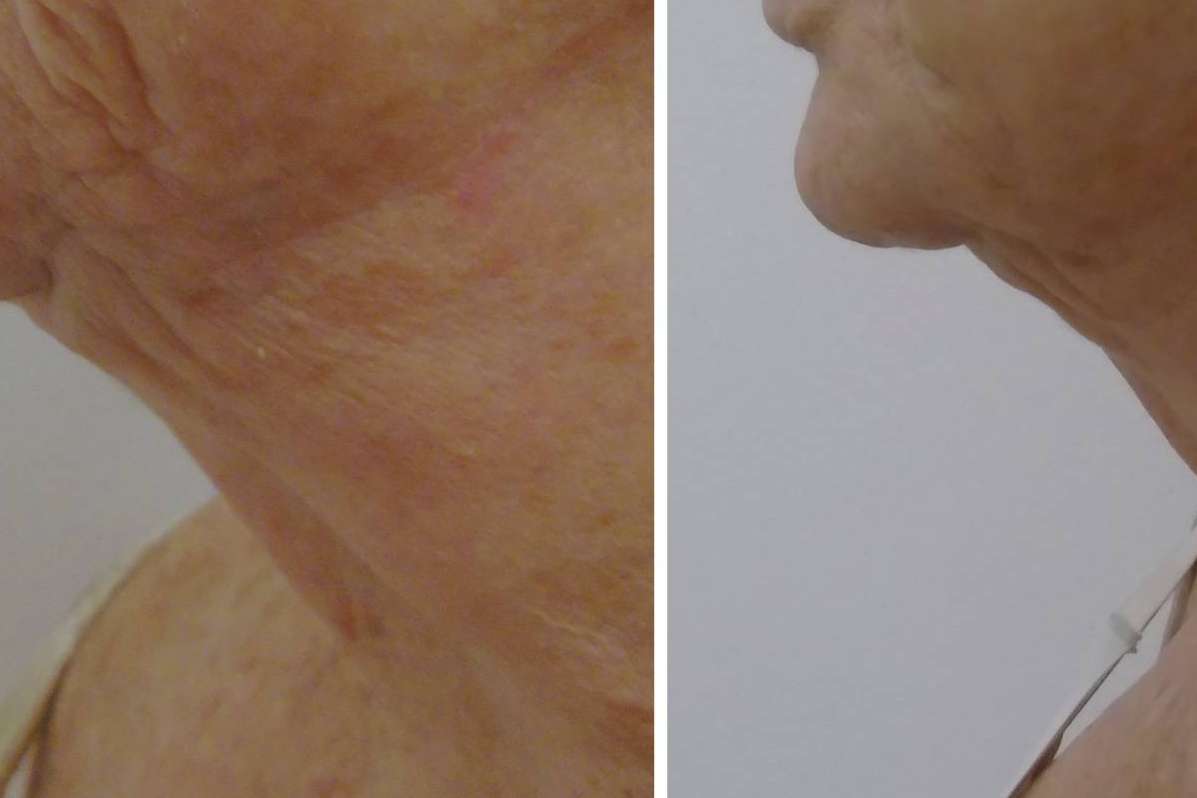 Dr. Tufet Madrid y Renophase, referentes en rejuvenecimiento del cuello