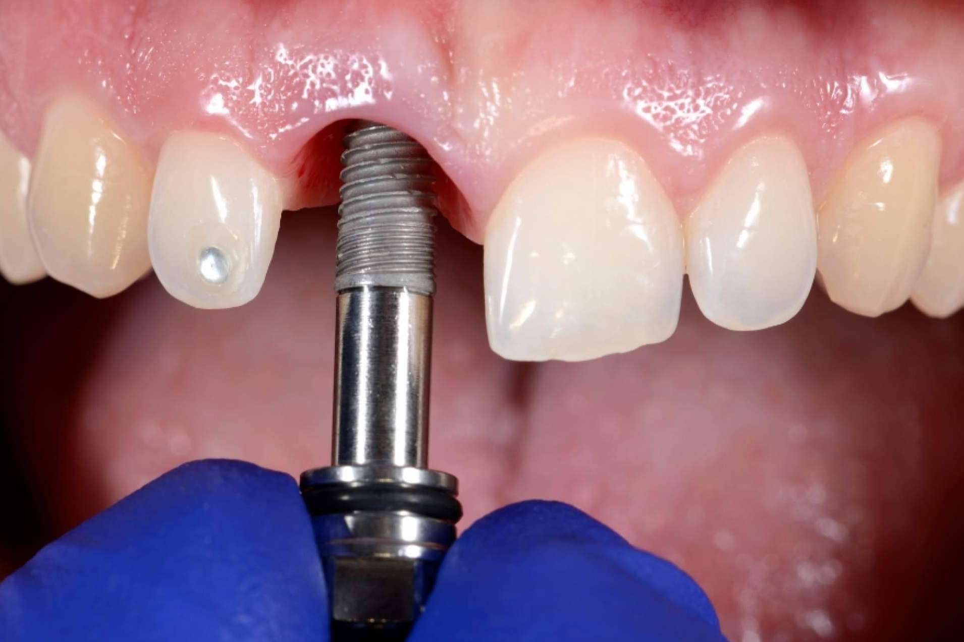 Ofertas en cirugías dentales; una práctica riesgosa para los pacientes, por Clínicas Nobel