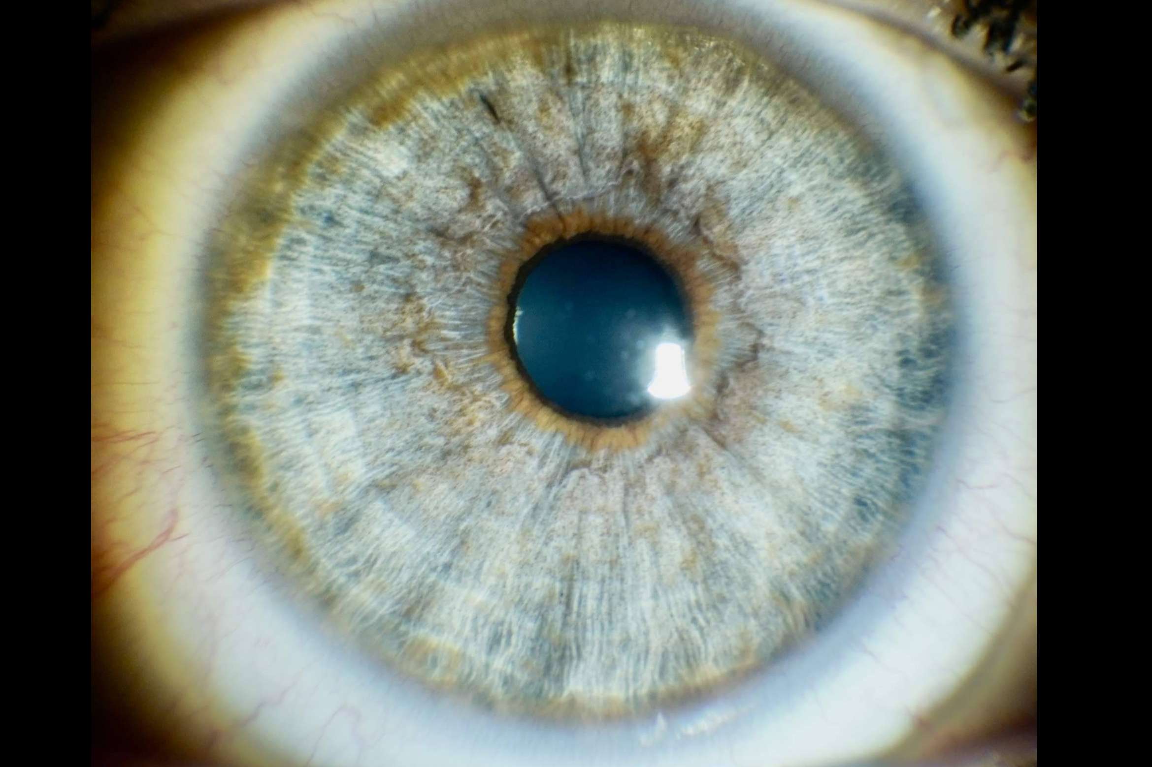 Eyecos responde a las preguntas más frecuentes sobre el cambio de color de ojos con láser