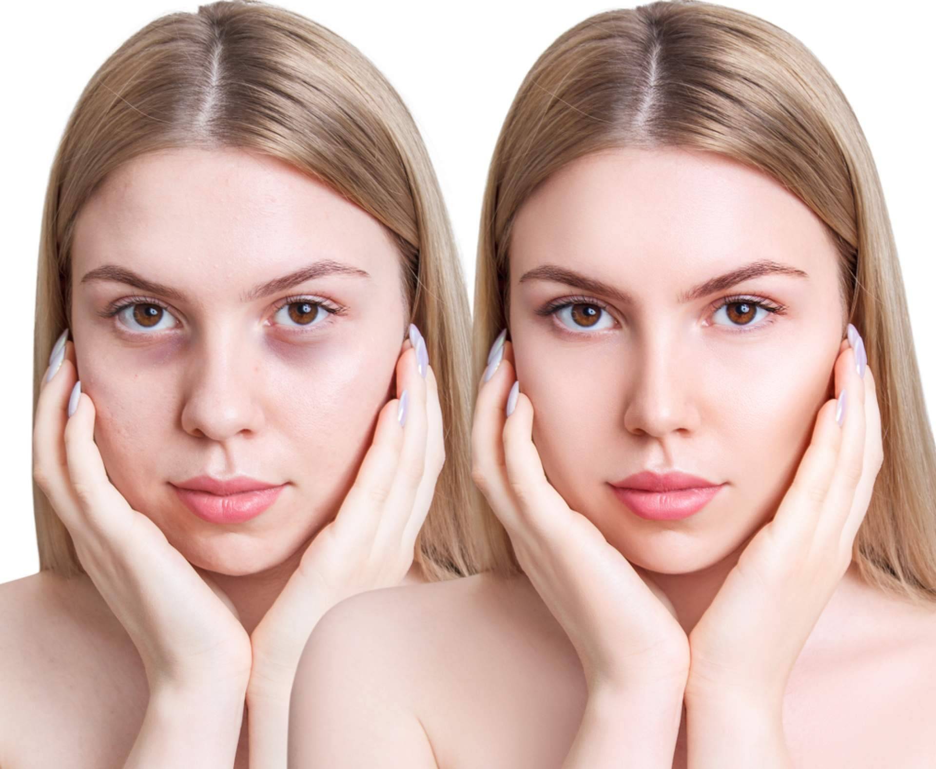 Relleno de ojeras con ácido hialurónico, una solución eficaz en Madrid con Centro Estética El Pilar