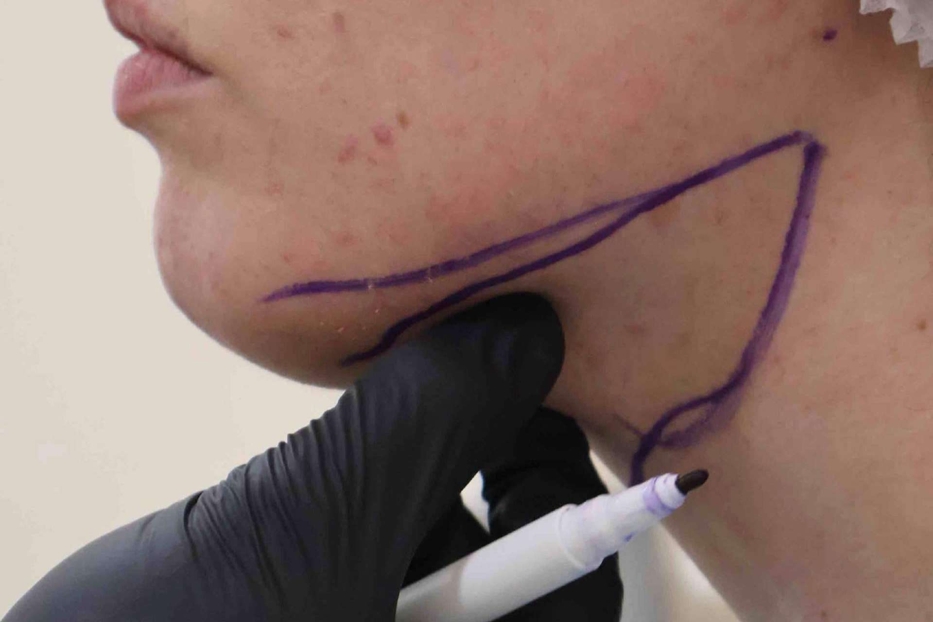 Descubrir la lipopapada en Clínica Roma