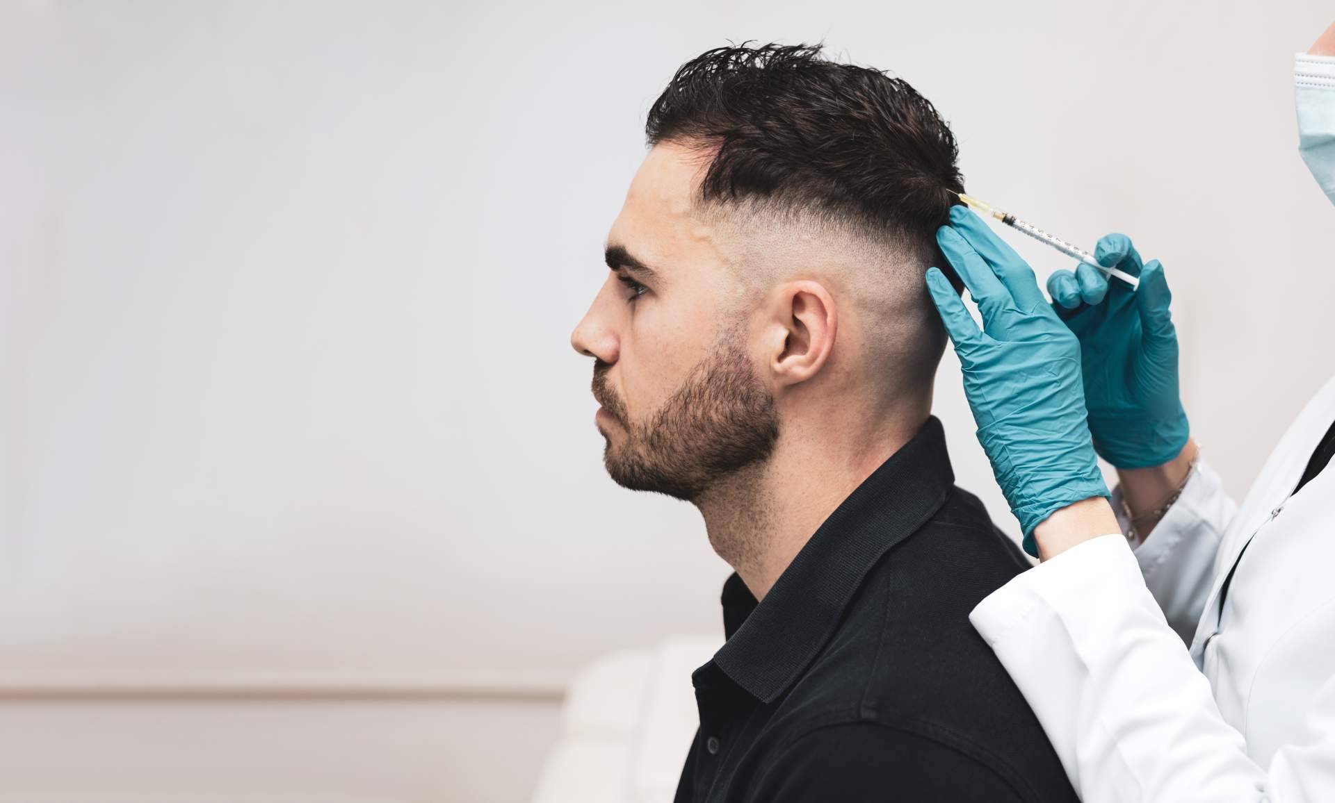 Recuperar el cabello sin pasar por quirófano; la alternativa al trasplante capilar que gana interés